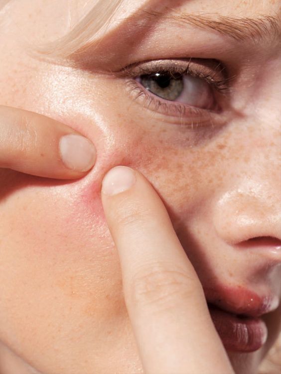 Acne Unveiled: Understanding Causes and Effective Solutions