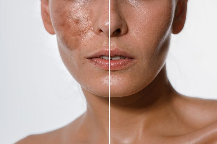 Pigmentation 101: What Causes It & How to Fade It